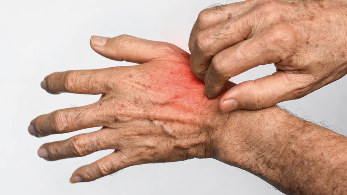 Psoriasis Treatment Appointment Near McLean, VA: Relief Options